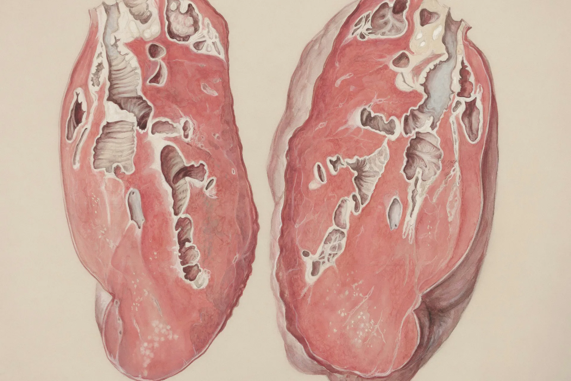 ¿Por qué a la tuberculosis le faltan defensores apasionados? ¿Por qué a la tuberculosis le faltan defensores apasionados?
